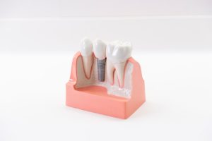 The Benefits of Digital Implant: Faster Healing, Better Results