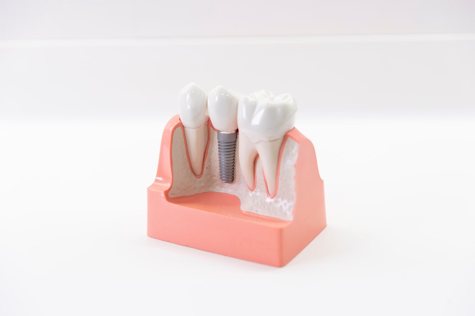 Implant Model